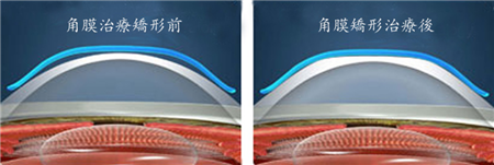 視力下降,兒童近視,預防近視,角膜塑形鏡