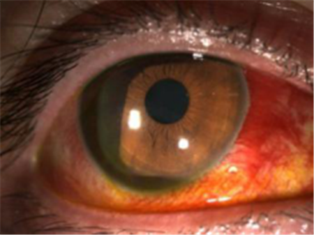 眼底出血,眼底疾病,眼底出血怎么辦 眼底出血,眼底疾病,眼底出血怎么辦