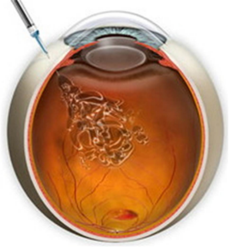 糖網(wǎng)病,視網(wǎng)膜病變,黃斑水腫治療,視網(wǎng)膜脫落治 糖網(wǎng)病,視網(wǎng)膜病變,黃斑水腫治療,視網(wǎng)膜脫落治
