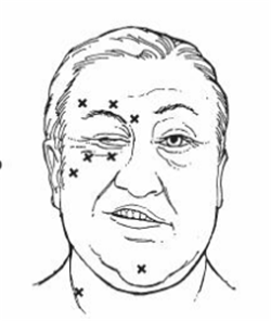 眼皮跳原因,眼皮跳怎么辦,眼瞼痙攣治療