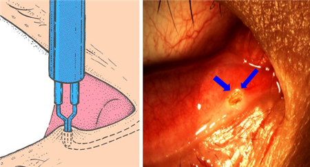 干眼癥原因,眼干眼澀怎么辦,干眼癥治療 干眼癥原因,眼干眼澀怎么辦,干眼癥治療
