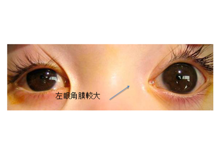青光眼,小兒青光眼,先天性青光眼,兒童青光眼治 青光眼,小兒青光眼,先天性青光眼,兒童青光眼治