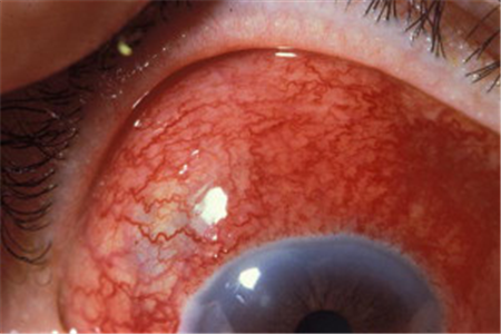 紅眼癥,鞏膜炎,鞏膜炎成因,鞏膜炎治療