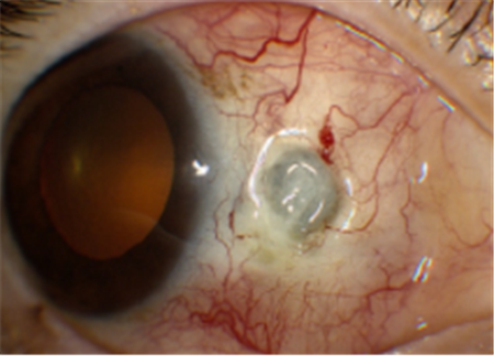 紅眼癥,鞏膜炎,鞏膜炎成因,鞏膜炎治療