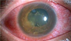 葡萄膜炎,葡萄膜炎癥狀,葡萄膜炎病因,葡萄膜炎 葡萄膜炎,葡萄膜炎癥狀,葡萄膜炎病因,葡萄膜炎