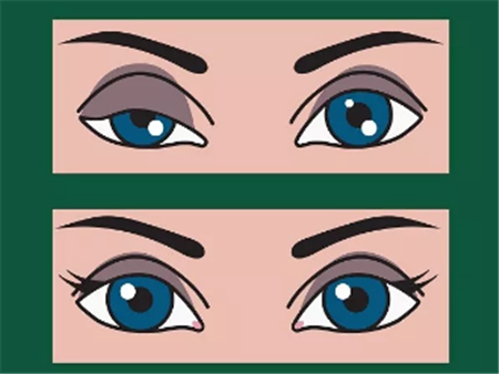 上瞼下垂,上瞼下垂治療,眼瞼下垂怎么辦 上瞼下垂,上瞼下垂治療,眼瞼下垂怎么辦