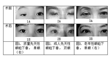 上瞼下垂,上瞼下垂治療,眼瞼下垂怎么辦 上瞼下垂,上瞼下垂治療,眼瞼下垂怎么辦