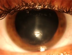 圓錐角膜,錐形角膜,圓錐角膜怎么辦,圓錐角膜治