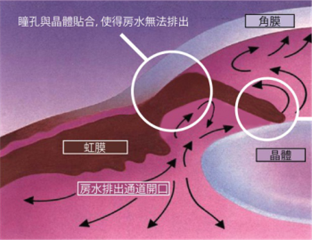 青光眼,關燈玩手機,閉角型青光眼,青光眼癥狀,青 青光眼,關燈玩手機,閉角型青光眼,青光眼癥狀,青