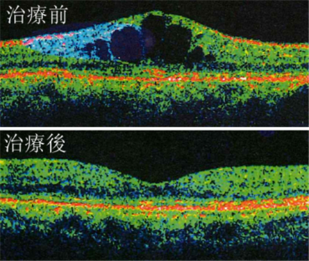 糖尿病,糖網病,糖尿病視網膜脫落,黃斑水腫 糖尿病,糖網病,糖尿病視網膜脫落,黃斑水腫