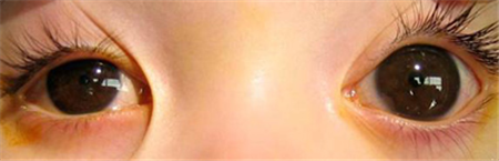 青光眼,兒童青光眼,先天性青光眼,青光眼治療 青光眼,兒童青光眼,先天性青光眼,青光眼治療