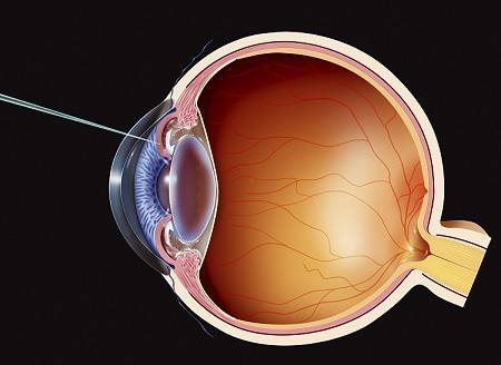 青光眼,兒童青光眼,先天性青光眼,青光眼治療 青光眼,兒童青光眼,先天性青光眼,青光眼治療