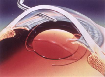 白內(nèi)障,小兒白內(nèi)障,兒童白內(nèi)障,白內(nèi)障治療