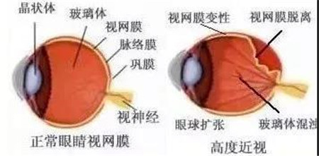 視網膜脫落,視網膜脫落癥狀,視網膜脫落治療