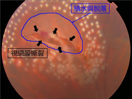 視網膜脫落,視網膜脫落癥狀,視網膜脫落治療