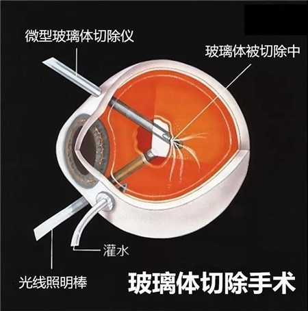 視網膜脫落,視網膜脫落癥狀,視網膜脫落治療