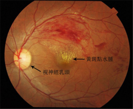 高血壓眼病,視網膜動脈阻塞,視網膜靜脈阻塞