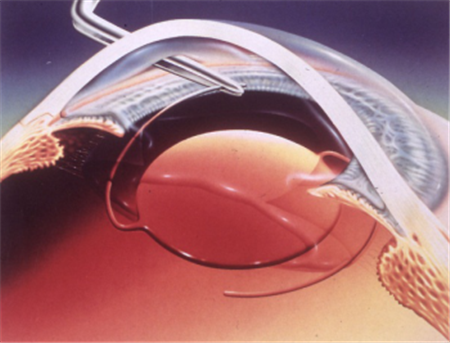 白內障,青光眼,白內障手術,青光眼治療 白內障,青光眼,白內障手術,青光眼治療