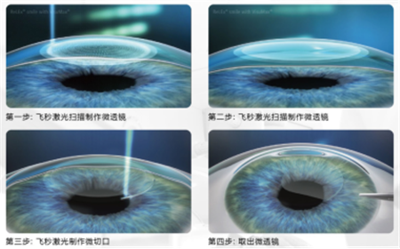 近視矯正,近視手術,激光近視手術,icl晶體植入術 近視矯正,近視手術,激光近視手術,icl晶體植入術