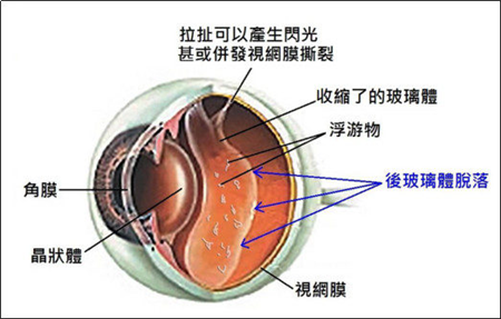 飛蚊癥怎么回事,飛蚊癥癥狀,飛蚊癥治療 飛蚊癥怎么回事,飛蚊癥癥狀,飛蚊癥治療