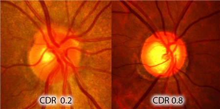 眼藥水,滴眼液怎么用,眼藥水怎么用,眼藥水使用 眼藥水,滴眼液怎么用,眼藥水怎么用,眼藥水使用