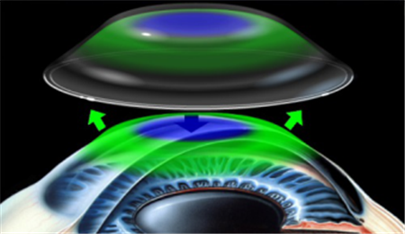 兒童近視,近視早期癥狀,近視矯正,角膜塑形鏡