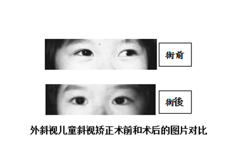 小兒斜視,兒童斜視,斜視治療,斜視矯正
