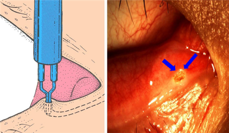 眼淚過(guò)多,眼干眼澀,干眼癥是什么,干眼癥治療 眼淚過(guò)多,眼干眼澀,干眼癥是什么,干眼癥治療