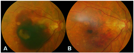 黃斑變性,吸煙傷眼,黃斑變性治療