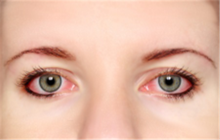 干眼癥,紅眼病,結膜炎,夏季眼病,眼睛防曬,紫外線 干眼癥,紅眼病,結膜炎,夏季眼病,眼睛防曬,紫外線