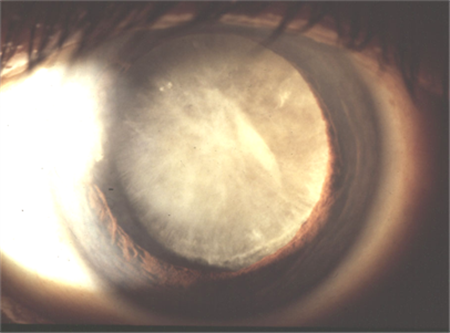 白內障怎么辦,白內障治療,白內障手術,白內障癥 白內障怎么辦,白內障治療,白內障手術,白內障癥