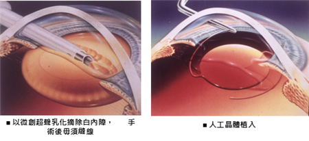 白內障怎么辦,白內障治療,白內障手術,白內障癥 白內障怎么辦,白內障治療,白內障手術,白內障癥