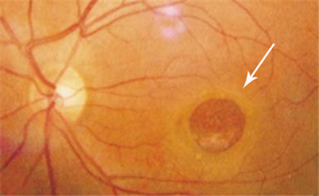 黃斑裂孔,黃斑裂孔怎么辦,黃斑裂孔治療,玻璃體 黃斑裂孔,黃斑裂孔怎么辦,黃斑裂孔治療,玻璃體