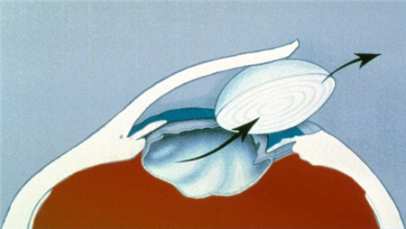 白內障手術,白內障手術夏天能做嗎,白內障術后護 白內障手術,白內障手術夏天能做嗎,白內障術后護