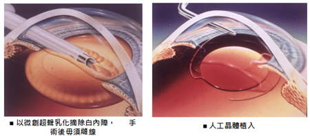 白內障手術,白內障手術夏天能做嗎,白內障術后護 白內障手術,白內障手術夏天能做嗎,白內障術后護
