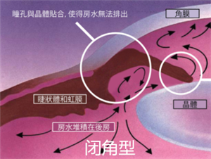 青光眼,閉角型青光眼,開角型青光眼,青光眼治療 青光眼,閉角型青光眼,開角型青光眼,青光眼治療
