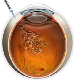 黃斑變性,黃斑變性分類,黃斑變性治療,黃斑病變 黃斑變性,黃斑變性分類,黃斑變性治療,黃斑病變