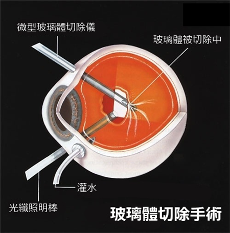 蹦極,高度近視,視網膜脫落,視網膜脫離,玻璃體切 蹦極,高度近視,視網膜脫落,視網膜脫離,玻璃體切