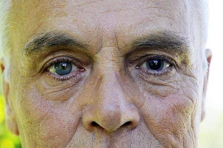 白內(nèi)障,白內(nèi)障手術(shù),白內(nèi)障治療,白內(nèi)障過(guò)熟 白內(nèi)障,白內(nèi)障手術(shù),白內(nèi)障治療,白內(nèi)障過(guò)熟