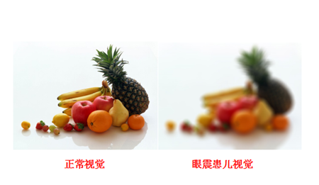 眼球震顫,兒童眼球震顫,先天性眼球震顫,眼球震