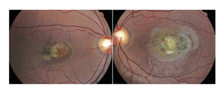 眼球震顫,兒童眼球震顫,先天性眼球震顫,眼球震