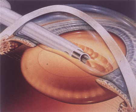 白內(nèi)障,白內(nèi)障治療,白內(nèi)障手術(shù),超聲乳化手術(shù) 白內(nèi)障,白內(nèi)障治療,白內(nèi)障手術(shù),超聲乳化手術(shù)