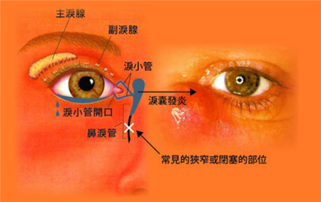 淚道阻塞,鼻淚管阻塞,先天性淚道阻塞,淚道探通 淚道阻塞,鼻淚管阻塞,先天性淚道阻塞,淚道探通