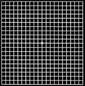 黃斑變性,黃斑病變,黃斑變性治療,玻璃體注射 黃斑變性,黃斑病變,黃斑變性治療,玻璃體注射