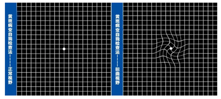 黃斑變性,黃斑病變,黃斑變性治療,玻璃體注射 黃斑變性,黃斑病變,黃斑變性治療,玻璃體注射