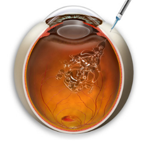 黃斑變性,黃斑病變,黃斑變性治療,玻璃體注射 黃斑變性,黃斑病變,黃斑變性治療,玻璃體注射