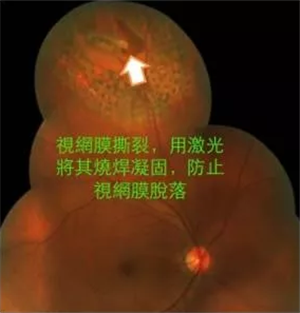 飛蚊癥,玻璃體是什么,飛蚊癥癥狀,飛蚊癥治療,飛 飛蚊癥,玻璃體是什么,飛蚊癥癥狀,飛蚊癥治療,飛