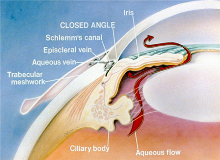 青光眼,急性青光眼,慢性青光眼,青光眼高危人群