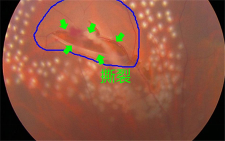 飛蚊癥,眼前有蚊子,飛蚊癥癥狀,飛蚊癥治療,飛蚊 飛蚊癥,眼前有蚊子,飛蚊癥癥狀,飛蚊癥治療,飛蚊