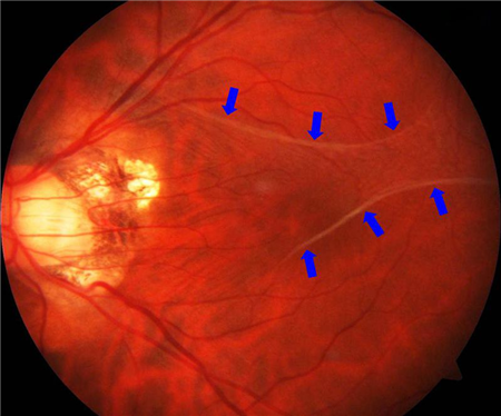 黃斑前膜,黃斑前膜手術,黃斑前膜治療 黃斑前膜,黃斑前膜手術,黃斑前膜治療